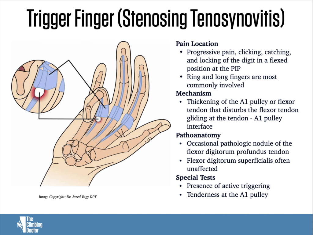 Trigger Finger Climbing - The Climbing Doctor