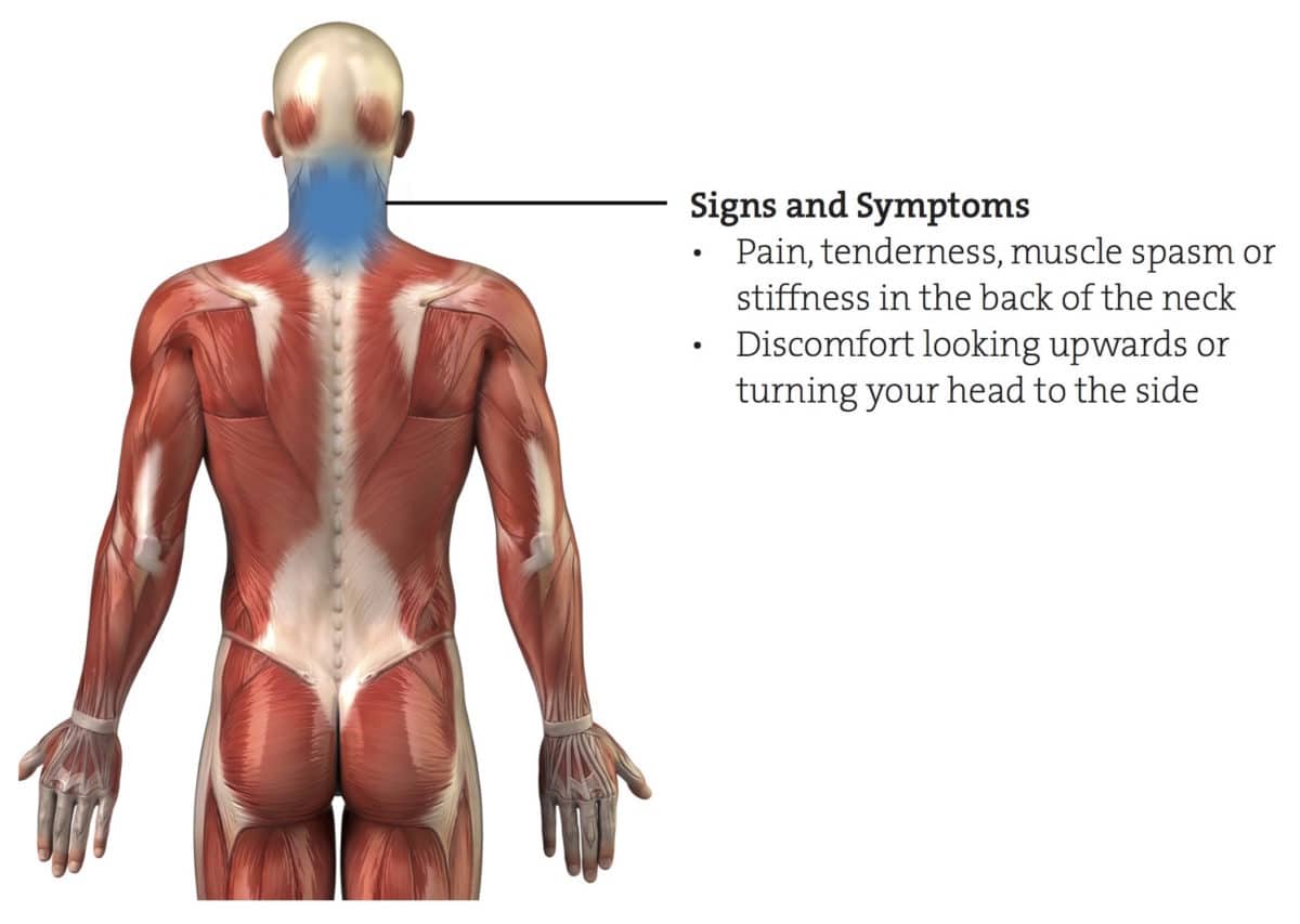 Neck Sprain Symptoms and What to Do About Them