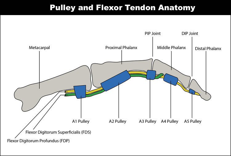 Finger Pulley Rupture