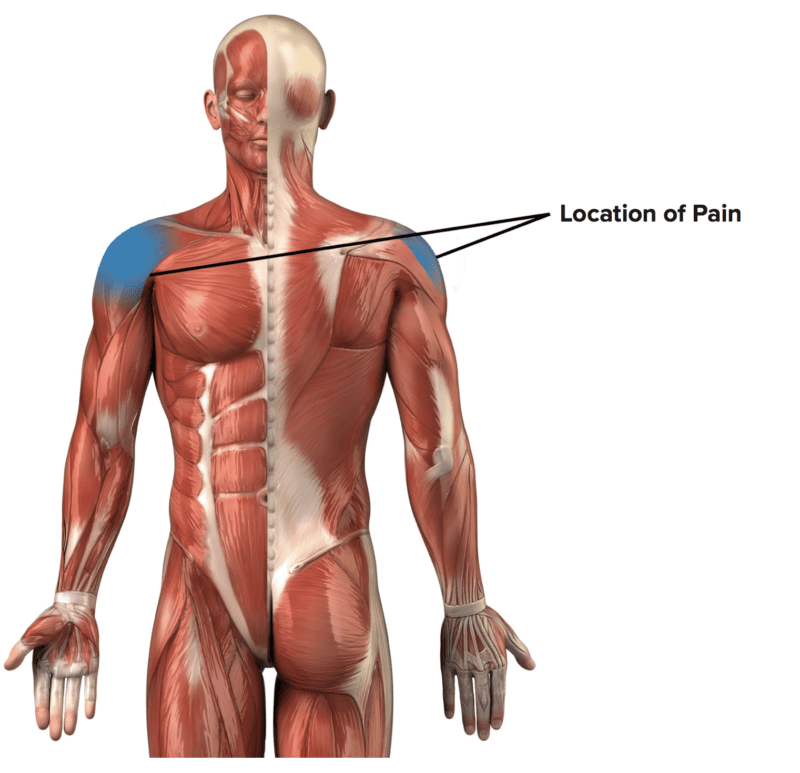 Shoulder Impingement Climbing Rehab Protocol