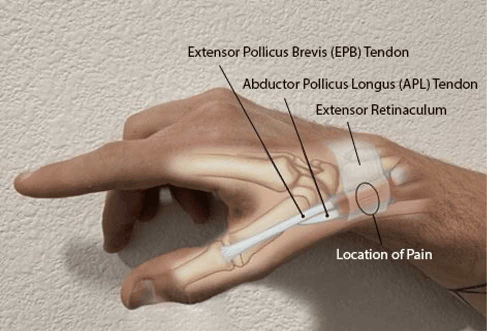 Exercise for sore wrist and online thumb