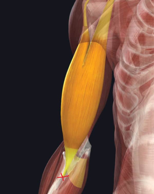 Brachialis Tendinopathy In Climbers The Climbing Doctor