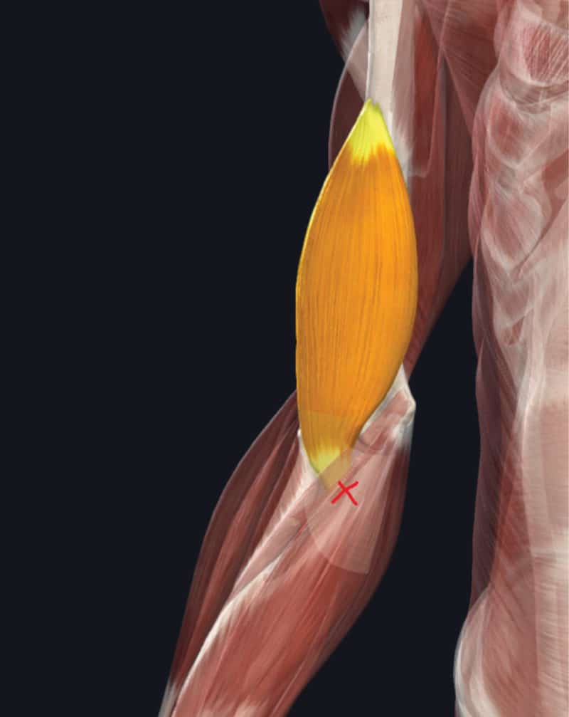 Brachialis Tendinopathy in Climbers The Climbing Doctor
