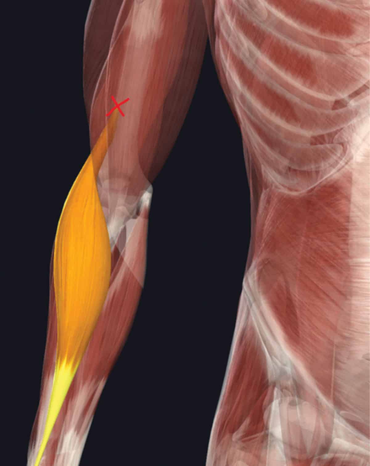 Brachialis Tendinopathy in Climbers - The Climbing Doctor