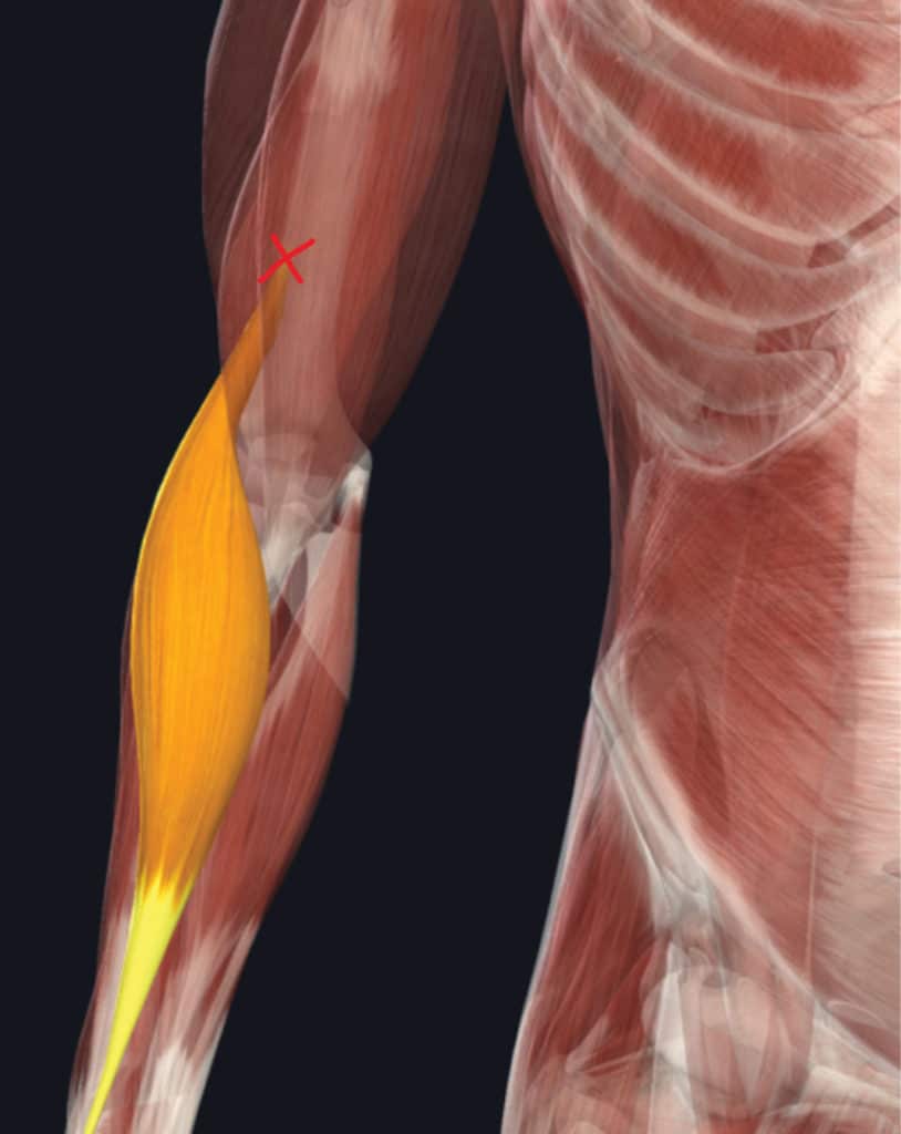 When thinking about the upper arm, the biceps and triceps are the first  muscles that come to mind. It is equally important to remember the  brachialis muscle, which is located right underneath