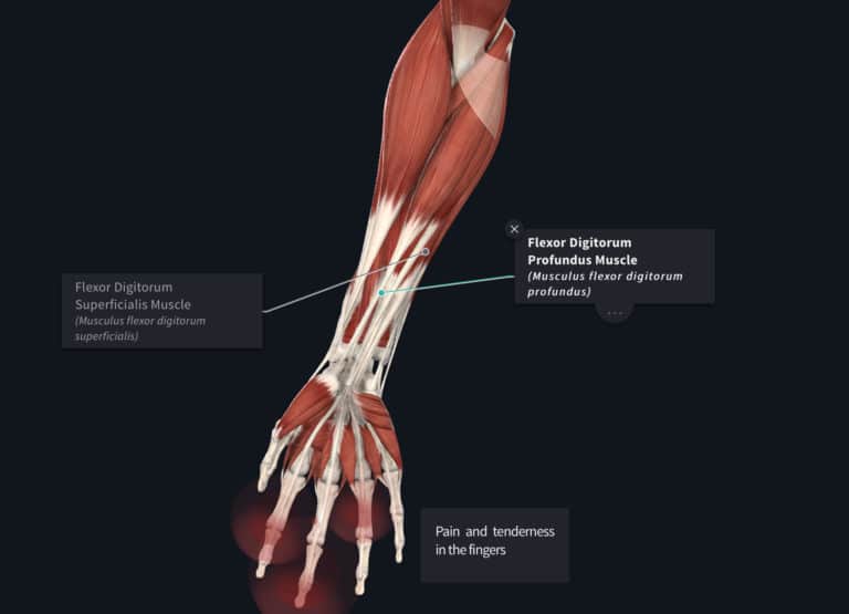 Rock Climbing Finger Tenosynovitis – The Climbing Doctor