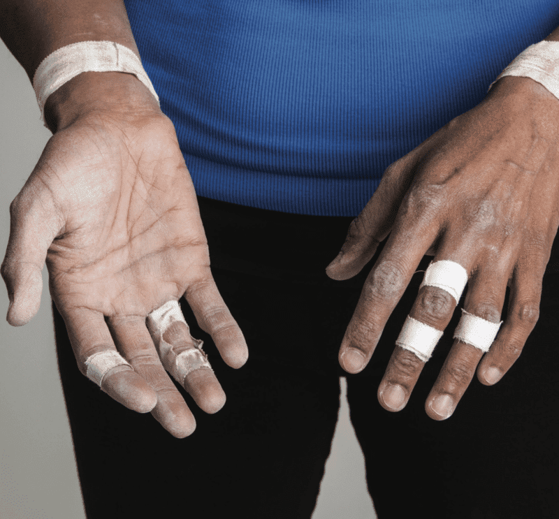 Rock Climbing Finger Tenosynovitis The Climbing Doctor