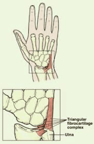kolbe guide dessert TFCC injury- A common source of wrist pain in climbers - The Climbing Doctor
