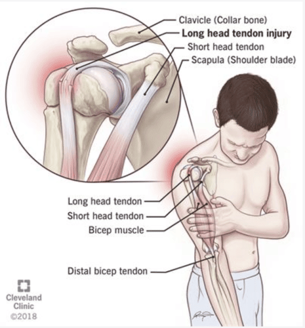 Long Head of the Biceps Tendinopathy The Climbing Doctor