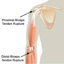 Supination Pronation Test  Distal Biceps Tendon Rupture 