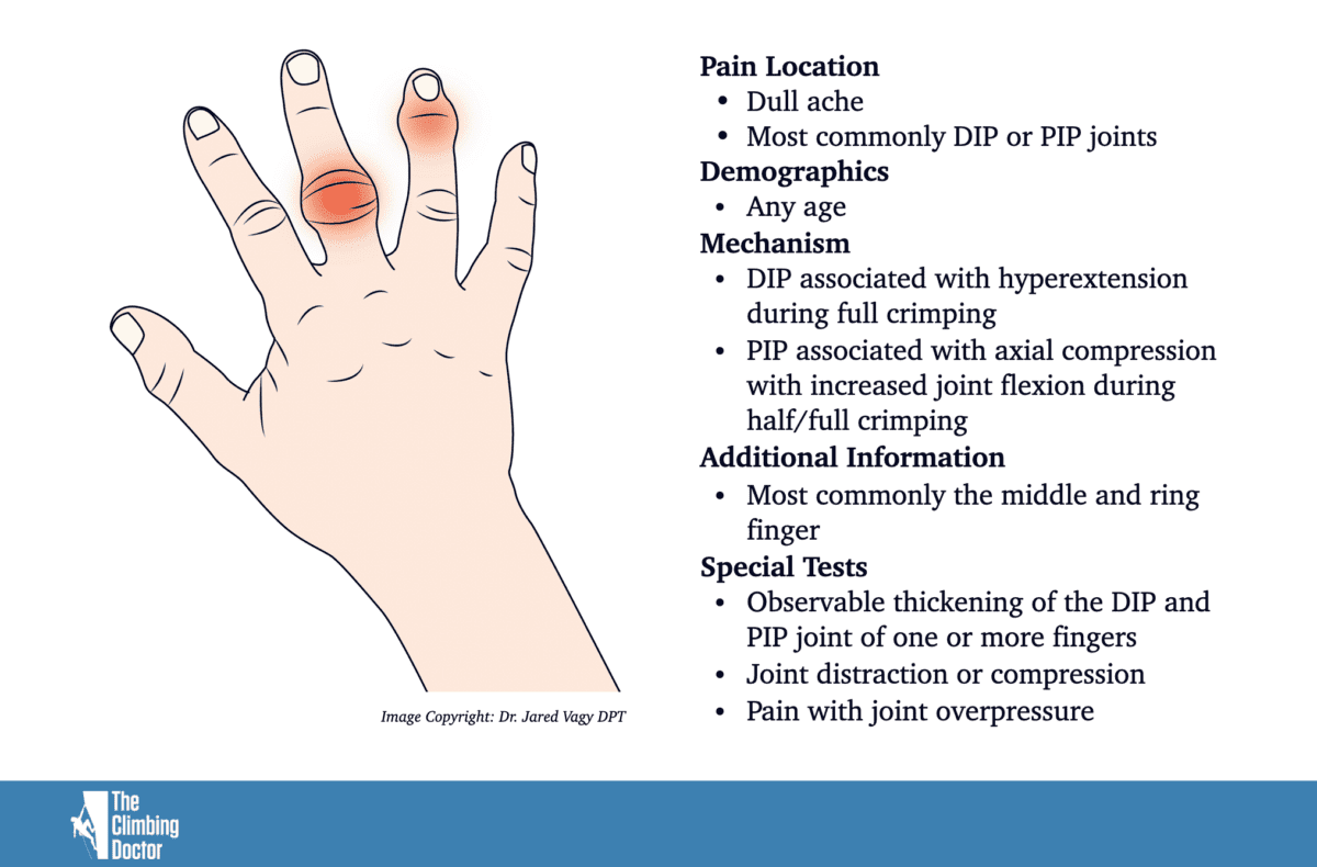 Capsulitis and Synovitis Climbing - Swelling of the Fingers - The ...