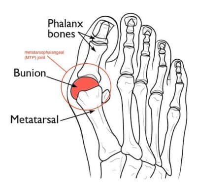 Footwork Techniques to Prevent or Reduce Bunion Pain - The Climbing Doctor