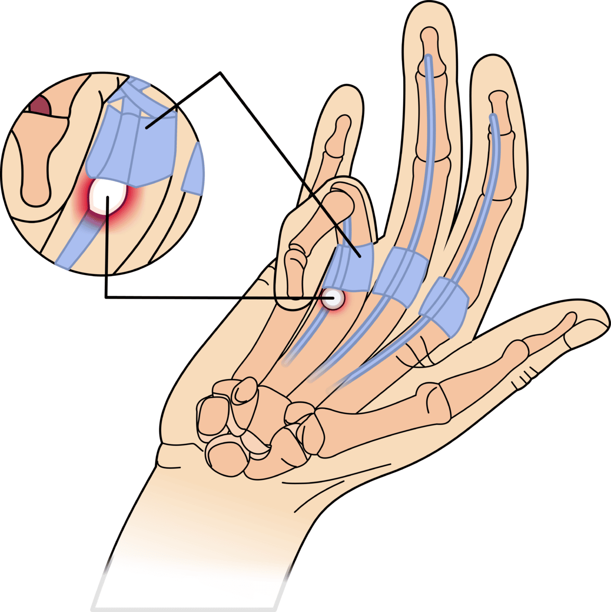 Trigger Finger The Climbing Doctor