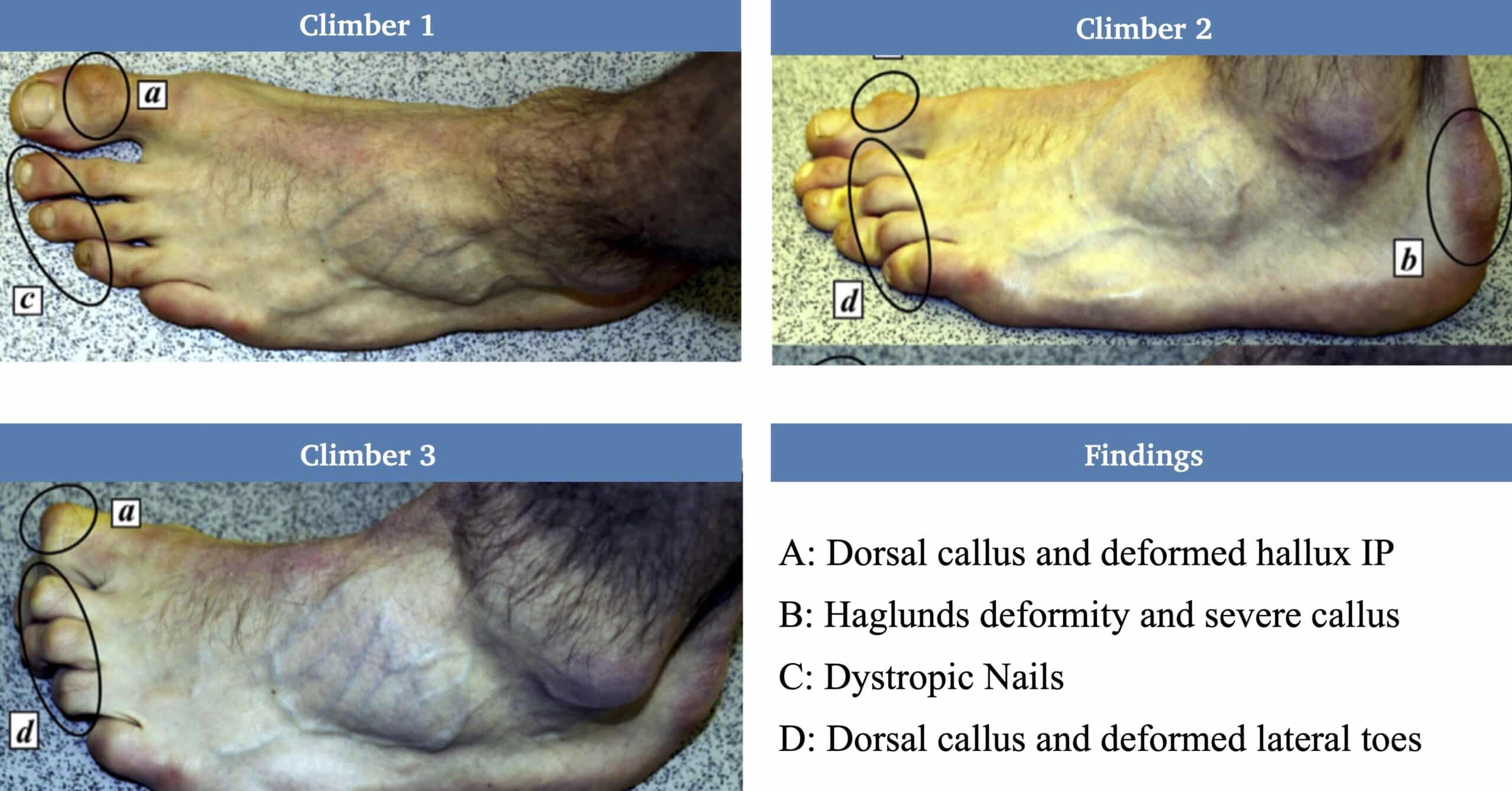 Example of an injury related to barefoot running: Hemorrhagic