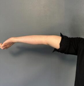 What is Hypermobility and How Does It Affect You_4